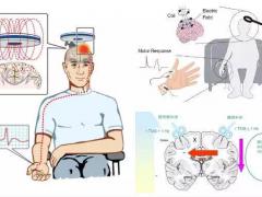 经颅磁刺激技术：什么是神经调控技术